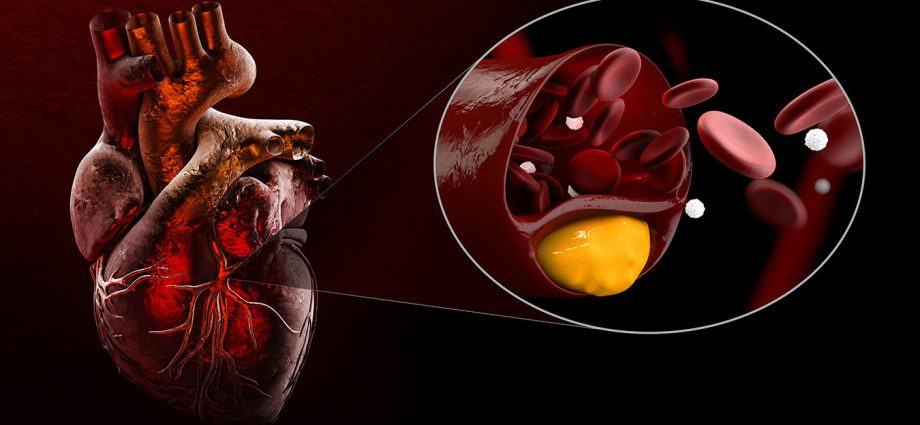 Hypercholesterolemia &#8211; an invisible civilization disease