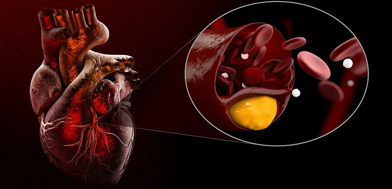 Hypercholesterolemia &#8211; an invisible civilization disease