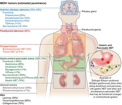 Hyperfunction of the parathyroid glands &#8211; causes, symptoms, diagnosis, treatment