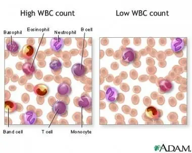 Hyperleukocytosis. Can too high white blood cell counts be dangerous?