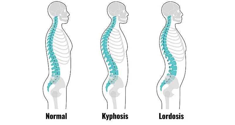 Hyperlordosis &#8211; causes, symptoms, treatment