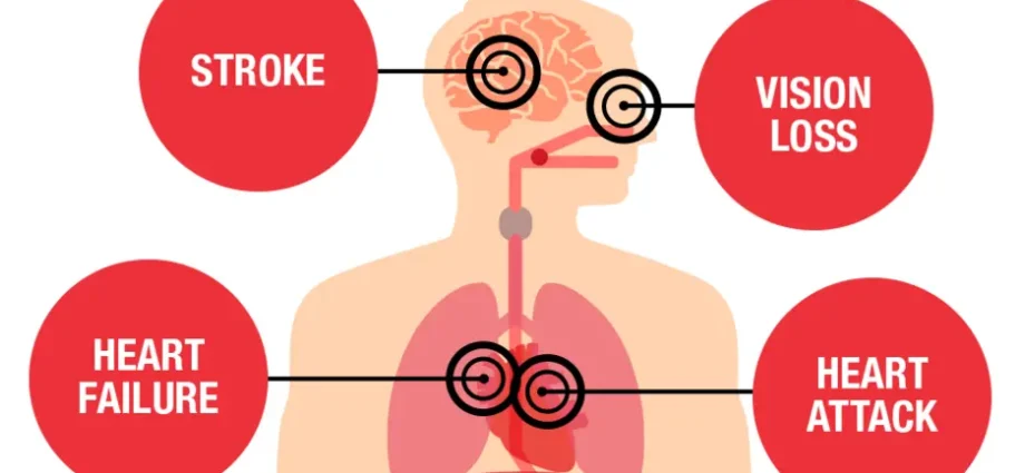 Hypertension can cause a fatal heart attack