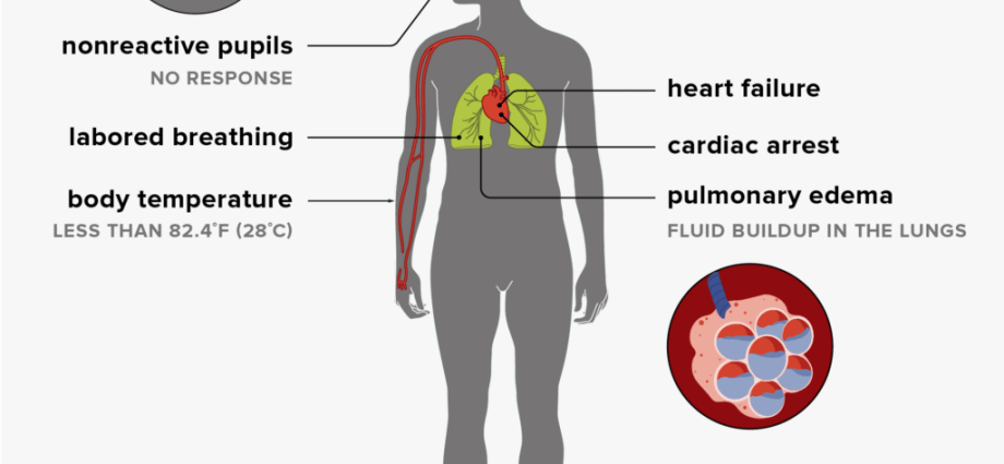 Hypothermia. What happens when the temperature of the human body drops?