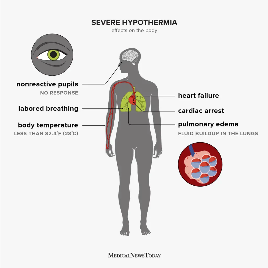 Hypothermia. What happens when the temperature of the human body drops?