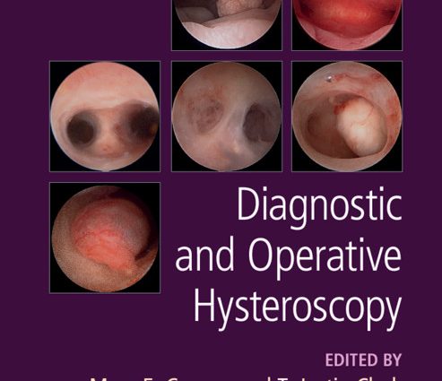 Hysteroscopy &#8211; indications, course, complications. Diagnostic and operational hysteroscopy