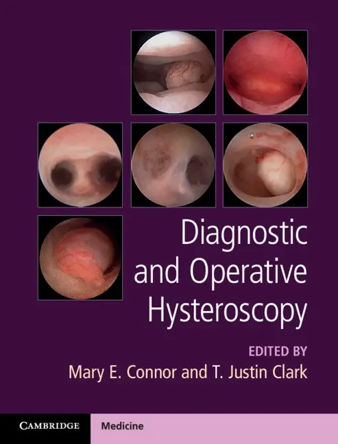 Hysteroscopy &#8211; indications, course, complications. Diagnostic and operational hysteroscopy