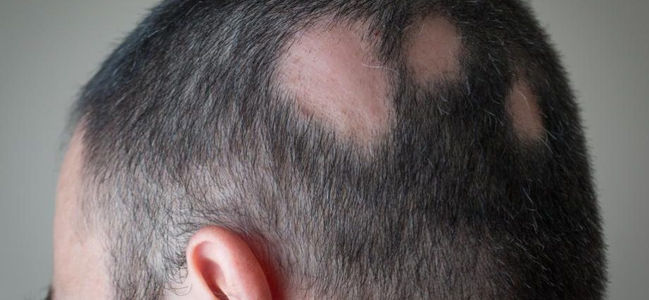 &#8220;I prefer not to have hair&#8221;. A new drug for alopecia areata arouses emotions