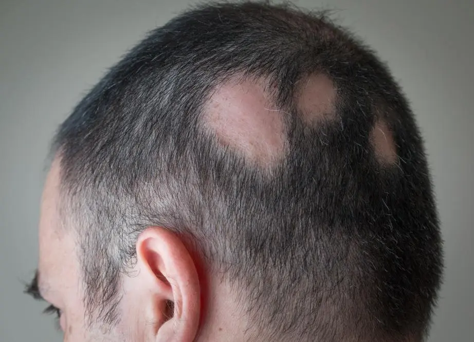 &#8220;I prefer not to have hair&#8221;. A new drug for alopecia areata arouses emotions