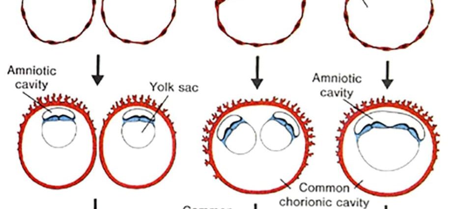 Identical twins, i.e. monozygotic pregnancy