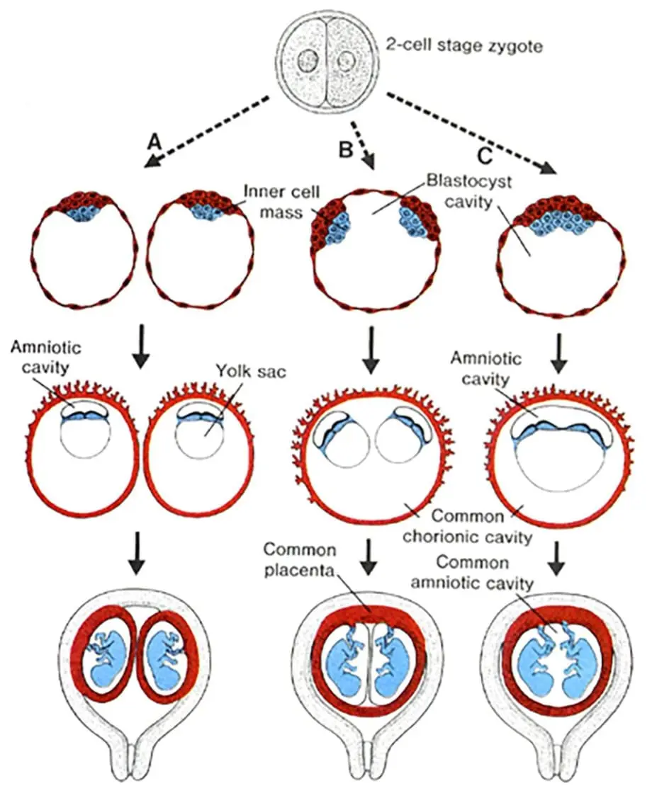 Identical twins, i.e. monozygotic pregnancy