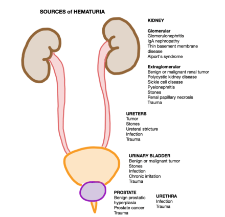 Idiopathic hematuria