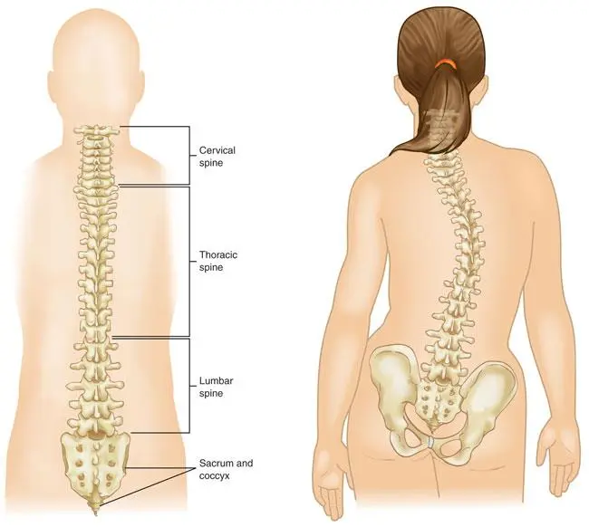 Idiopathic scoliosis