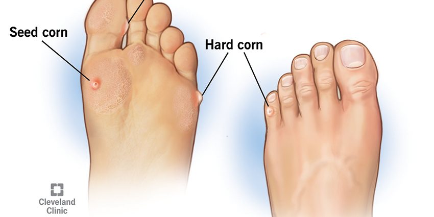 Imprint on the foot. How are calluses and corns removed?