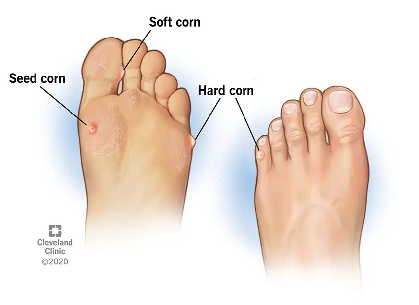 Imprint on the foot. How are calluses and corns removed?