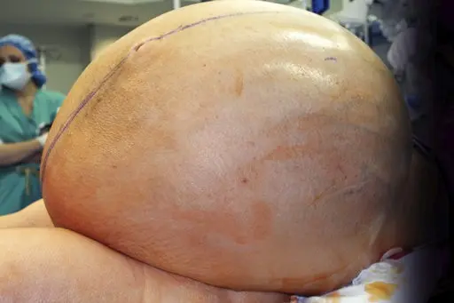 In a hospital in Poznań, a giant cancerous tumor was removed