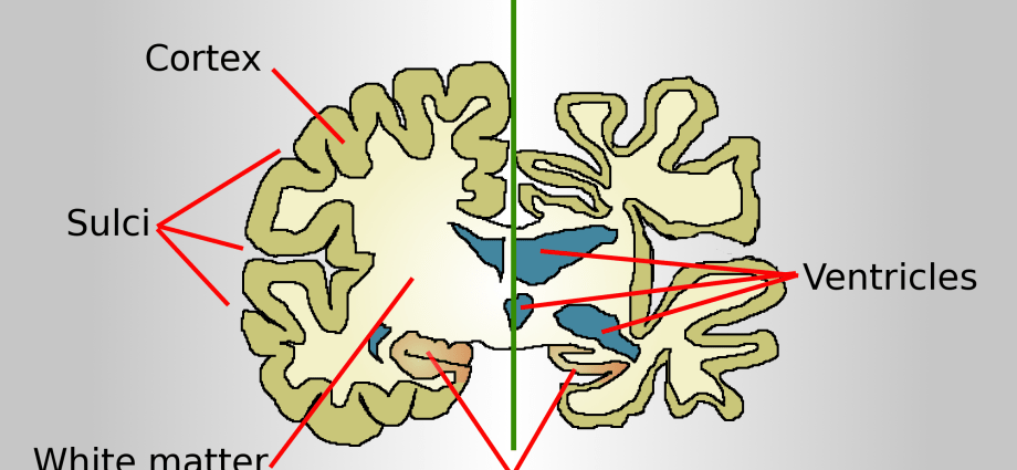 In Alzheimer&#8217;s disease, the brain shrinks and shrinks. Why? Explains the neurologist