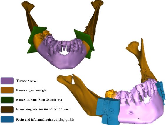 In Olsztyn, jaw reconstruction surgery with a new method