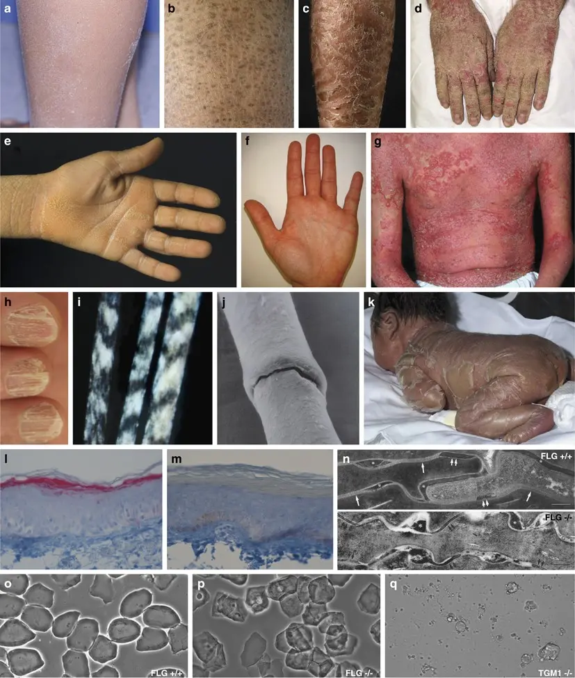 Inborn ichthyosis erythroderma, non-blistering variety