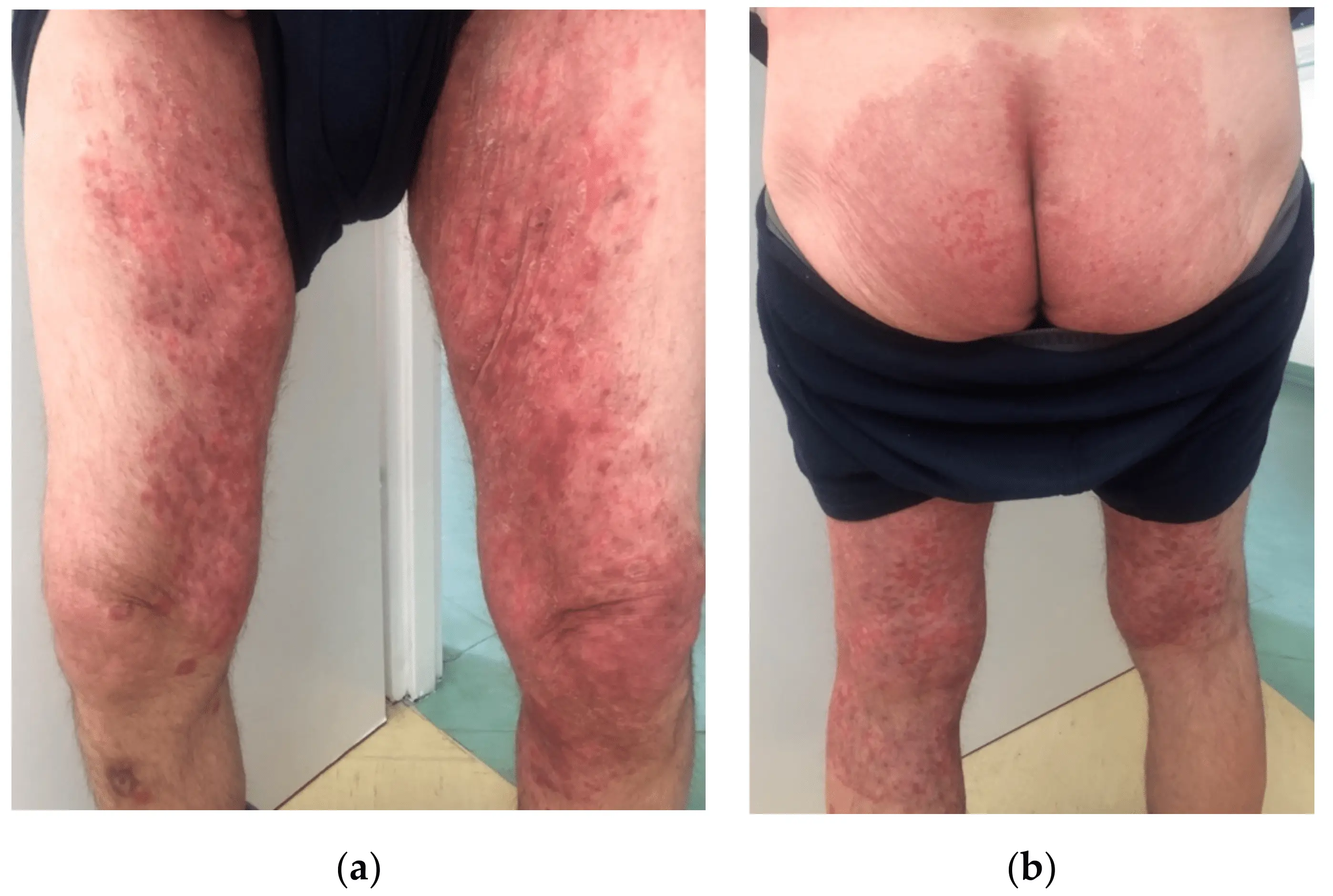 Incognito mycosis &#8211; how does it manifest itself and with what can it be confused?