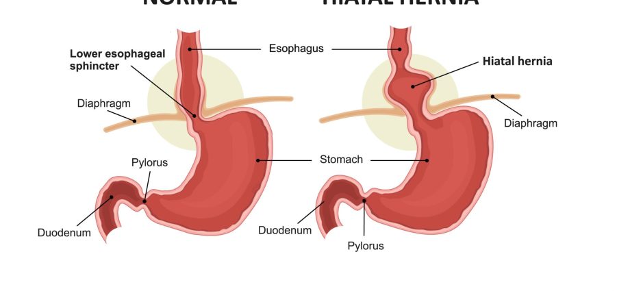 Indigestion or a hiatal hernia?