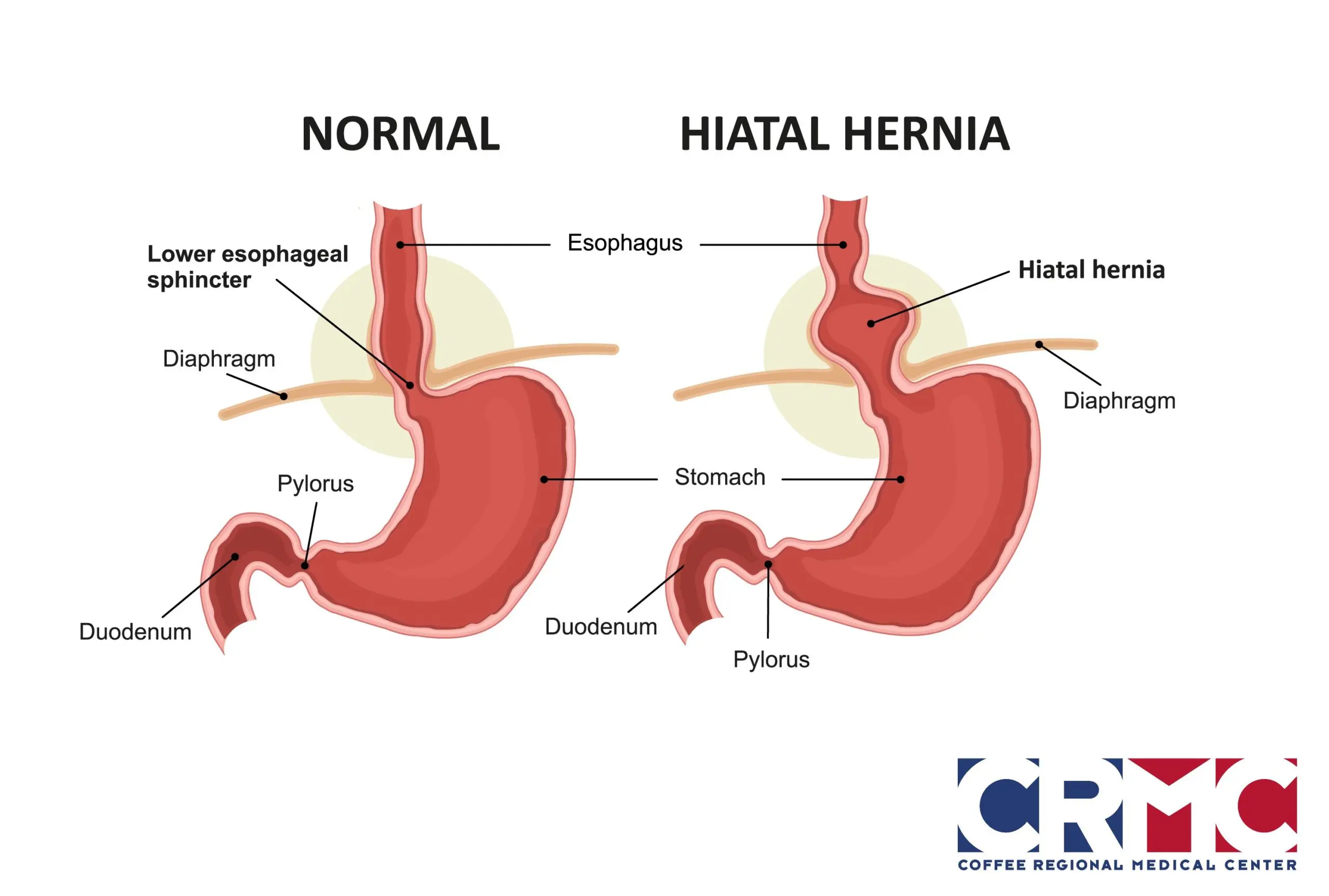 Indigestion or a hiatal hernia?