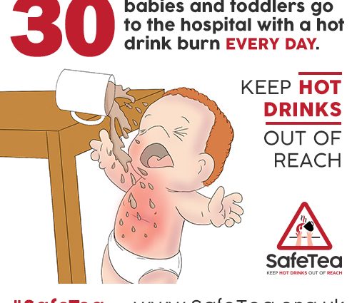 Infant burns &#8211; causes and prevention