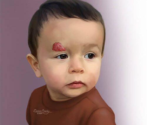 Infantile hemangioma &#8211; types, symptoms, treatment. How to care for baby&#8217;s skin?