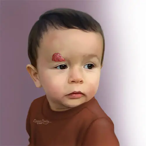 Infantile hemangioma &#8211; types, symptoms, treatment. How to care for baby&#8217;s skin?