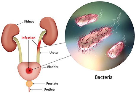 Infection with E. coli