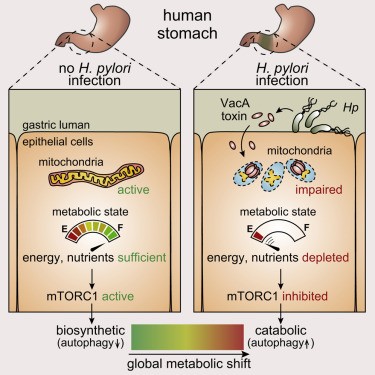 Infection with Helicobacter pylori