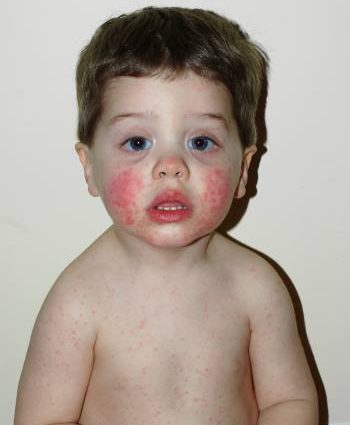 Infectious erythema in children &#8211; symptoms and treatment. How long does it take?