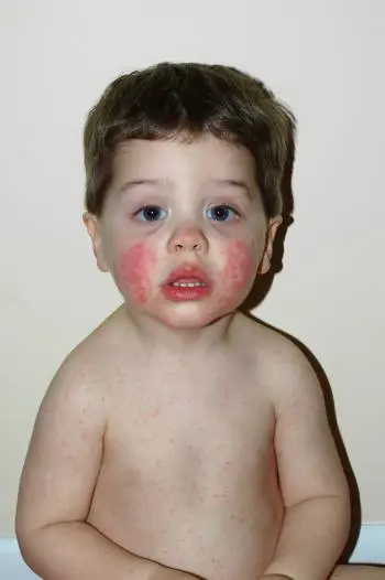 Infectious erythema in children &#8211; symptoms and treatment. How long does it take?