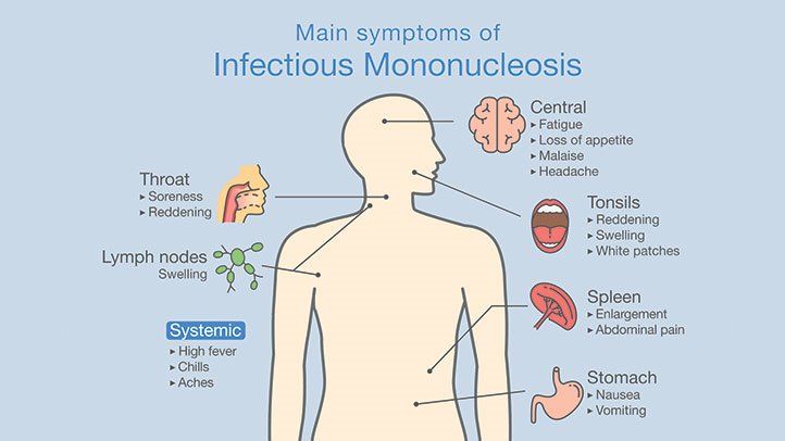 Infectious mononucleosis &#8211; symptoms, treatment, complications. Mononucleosis in children