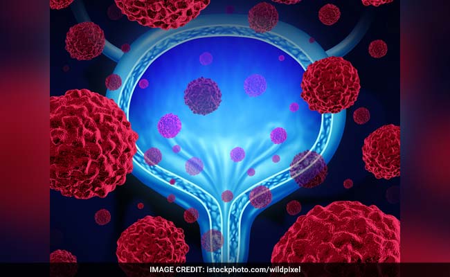 Infertility increases the risk of aggressive prostate cancer