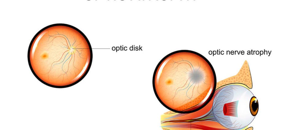 Inflammation and atrophy of the optic nerve &#8211; treatment