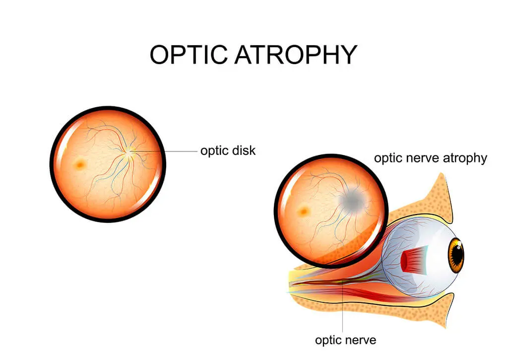 Inflammation and atrophy of the optic nerve &#8211; treatment