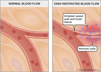 Inflammation of small vessels