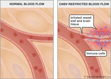 Inflammation of small vessels