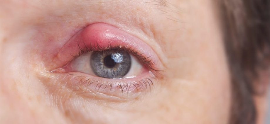 Inflammation of the edges of the eyelids and eyelid glands. The most common symptoms