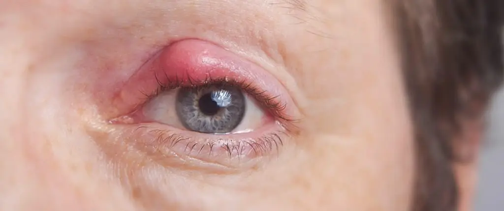 Inflammation of the edges of the eyelids and eyelid glands. The most common symptoms