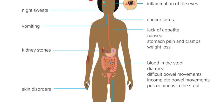 Inflammation of the intestines &#8211; causes, symptoms, treatment