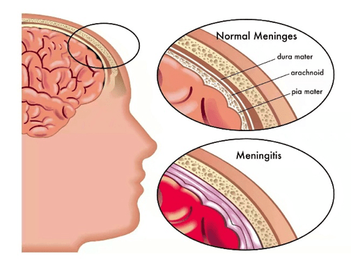 Inflammation i hjärnhinnan och hjärnan