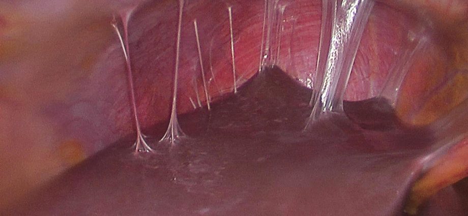 Inflammation of the perihepatic tissue