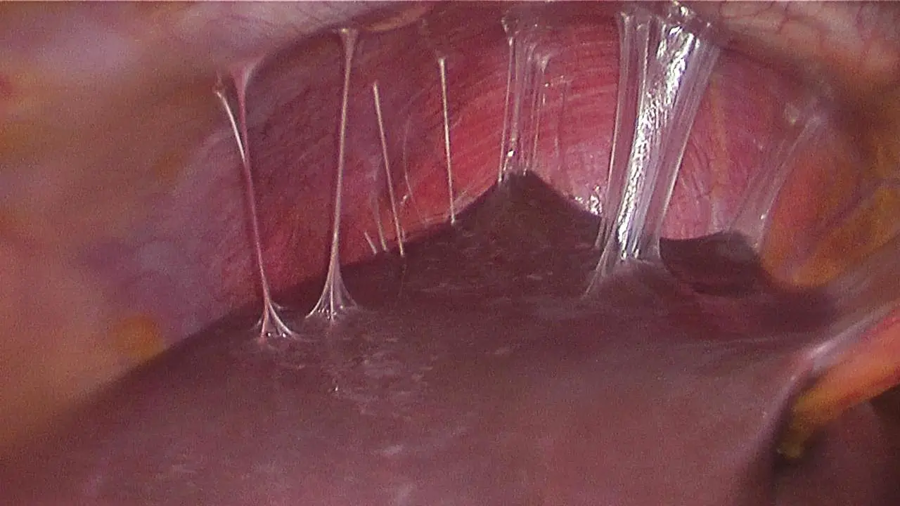 Inflammation of the perihepatic tissue