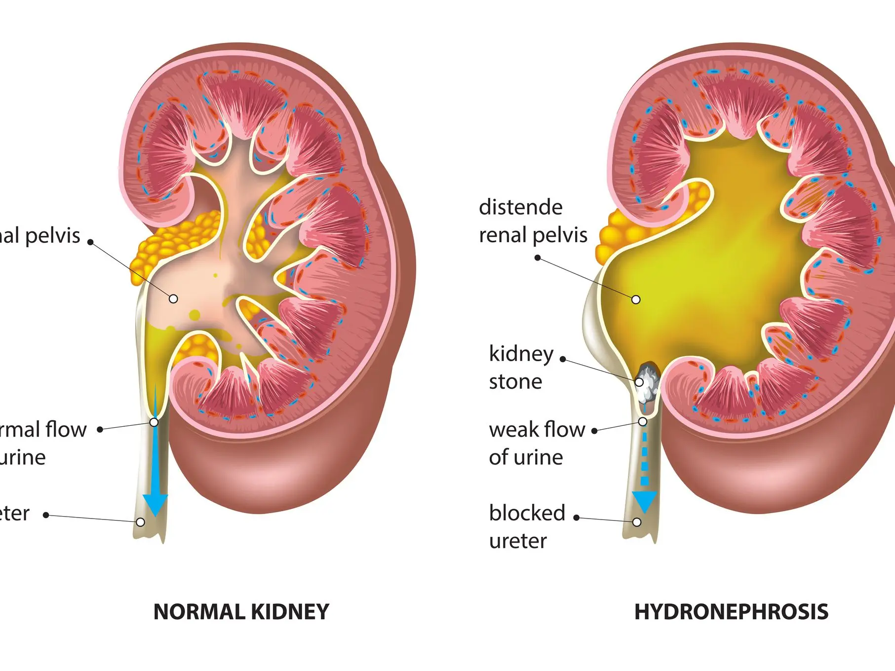 Non Obstructive Calculi Meaning