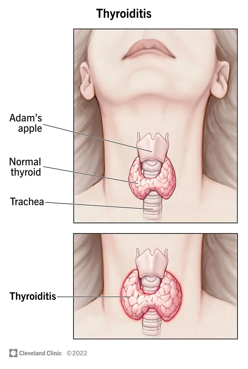 Inflammation of the thyroid gland