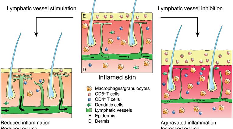 Inflammation of the vessels and lymph nodes