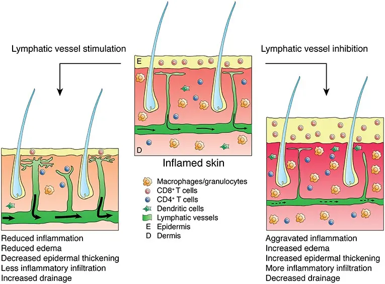 Inflammation of the vessels and lymph nodes