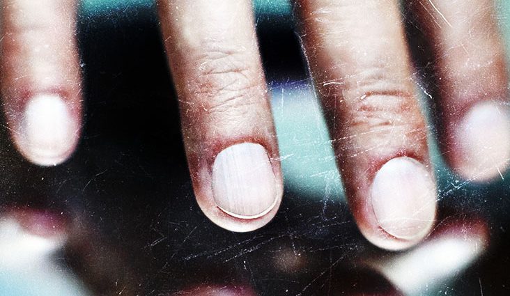 Ingrown hairs, black mark under the fingernail and eyesight problem. These are atypical symptoms of a fatal tumor