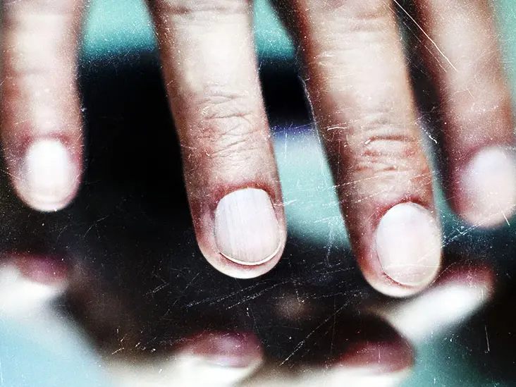 Ingrown hairs, black mark under the fingernail and eyesight problem. These are atypical symptoms of a fatal tumor